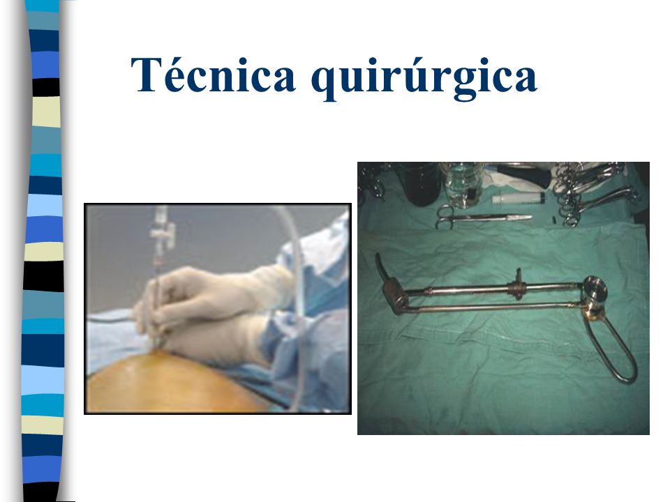 histerectomia abdominal tecnica quirurgica slideshare